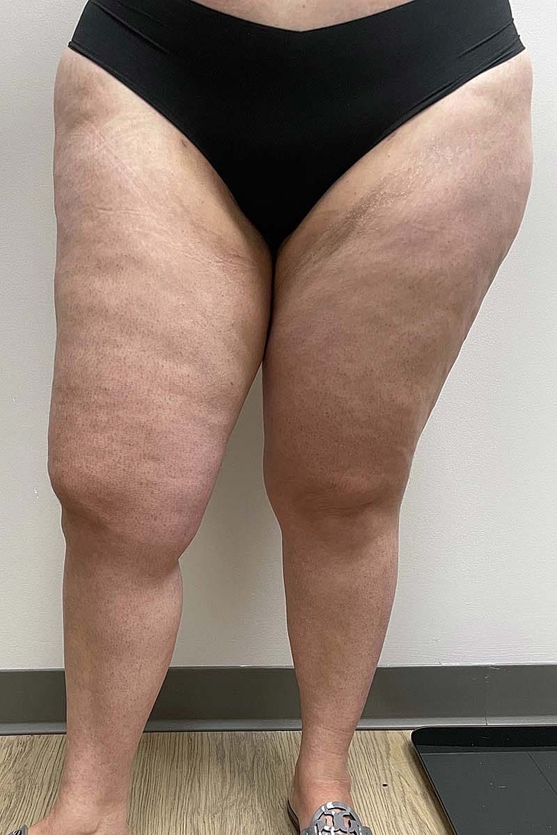 Liposuction Thighs Before & After