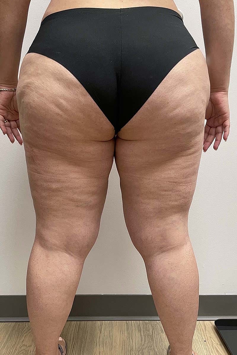 Liposuction Thighs Before & After