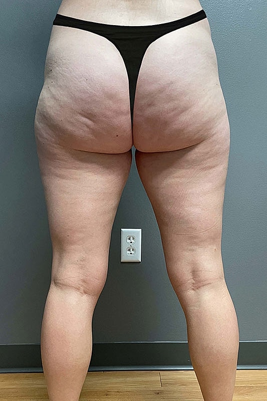 Liposuction Thighs Before & After