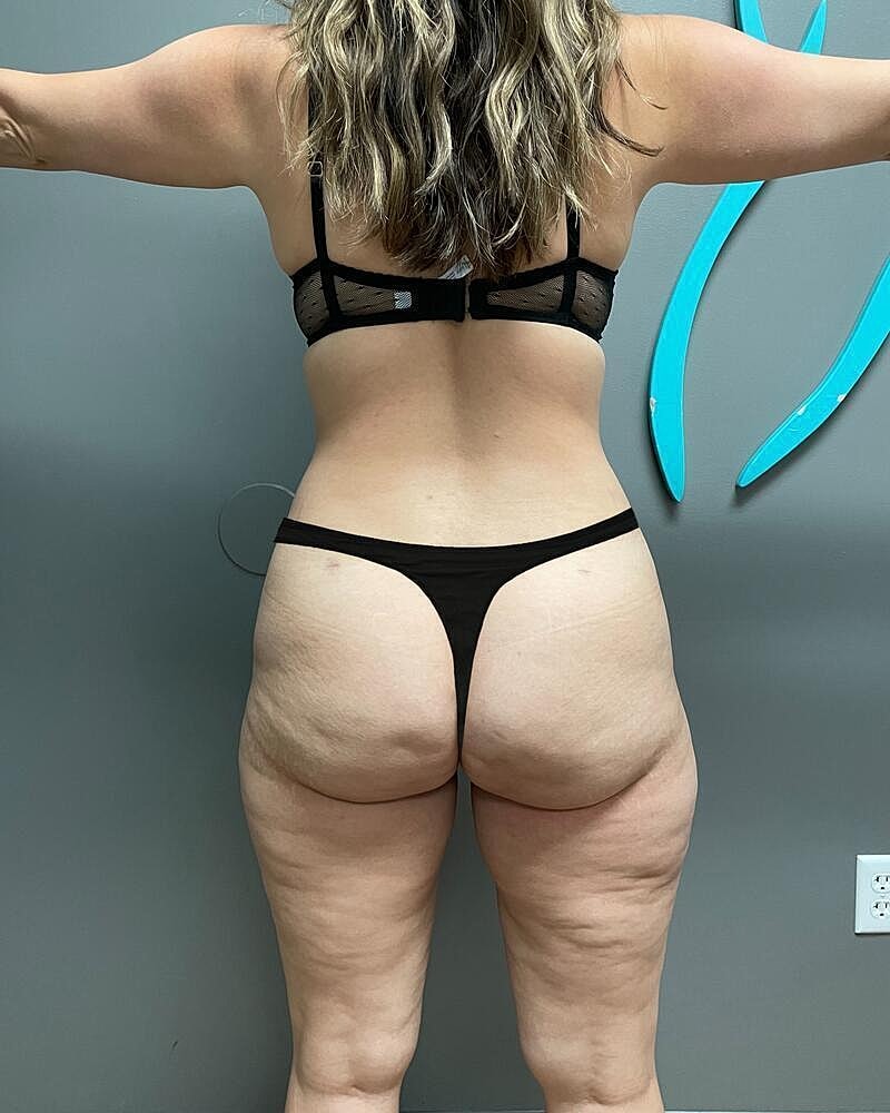 Liposuction Thighs Before & After