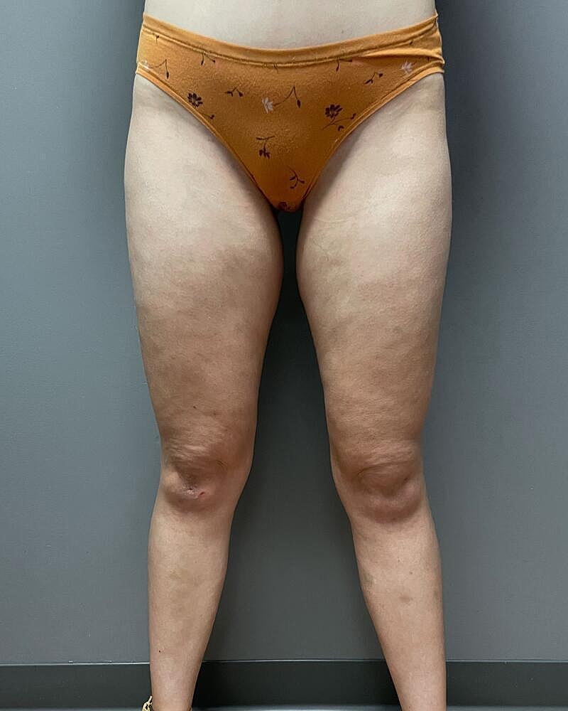 Liposuction Thighs Before & After