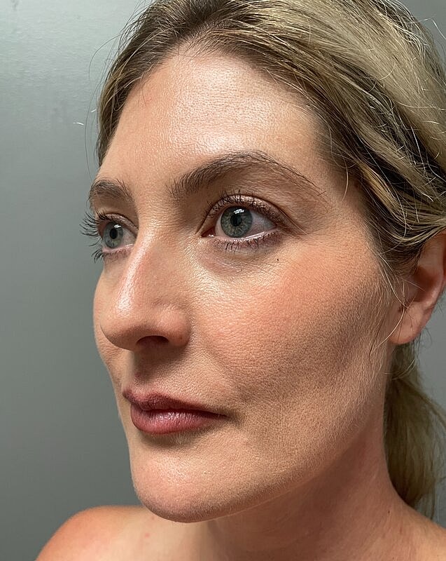 Upper Lip Lift Before & After