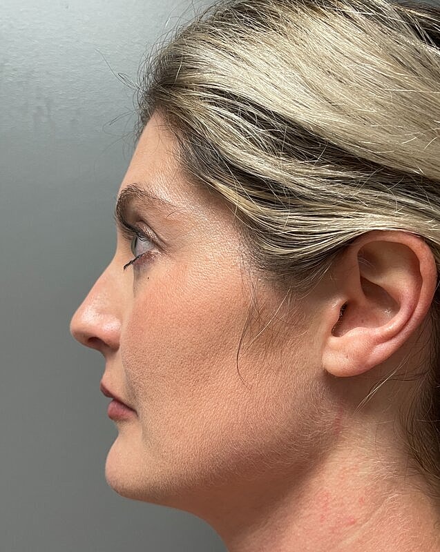 Upper Lip Lift Before & After