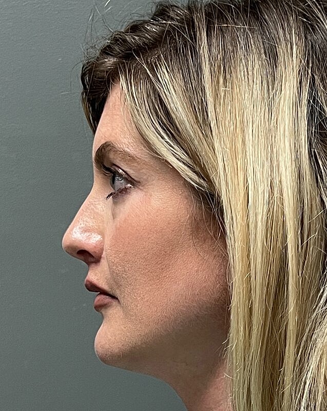 Upper Lip Lift Before & After