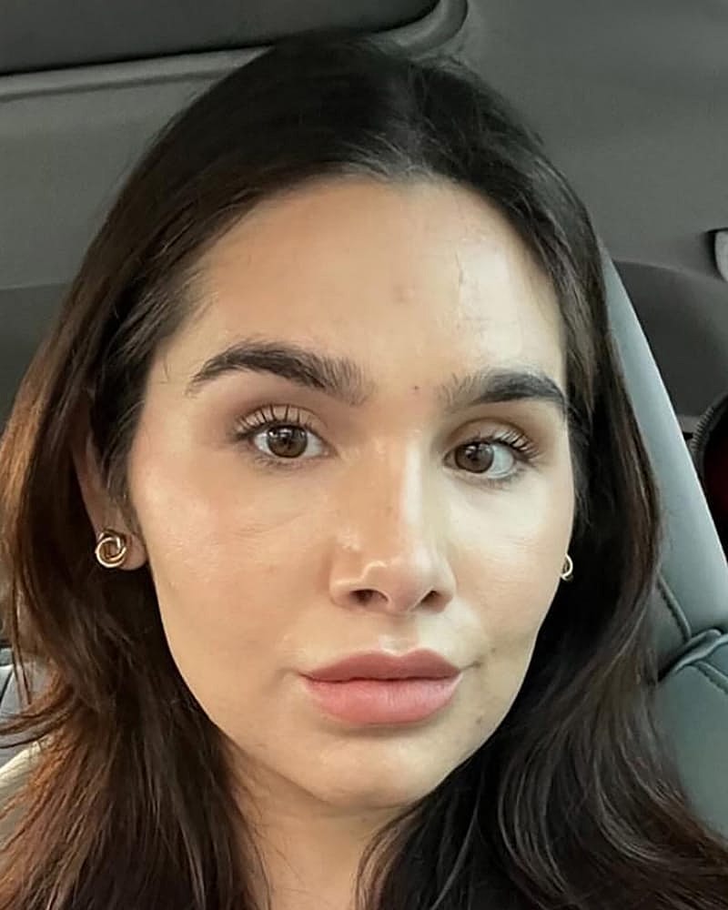 Upper Lip Lift Before & After