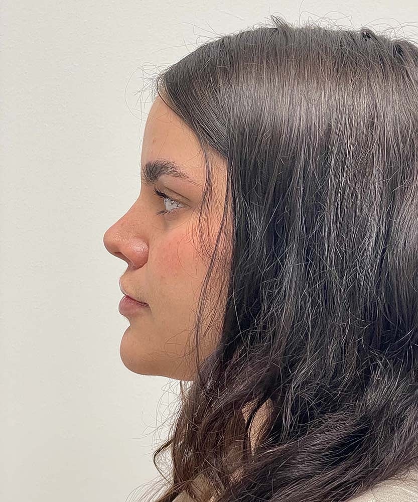 Upper Lip Lift Before & After