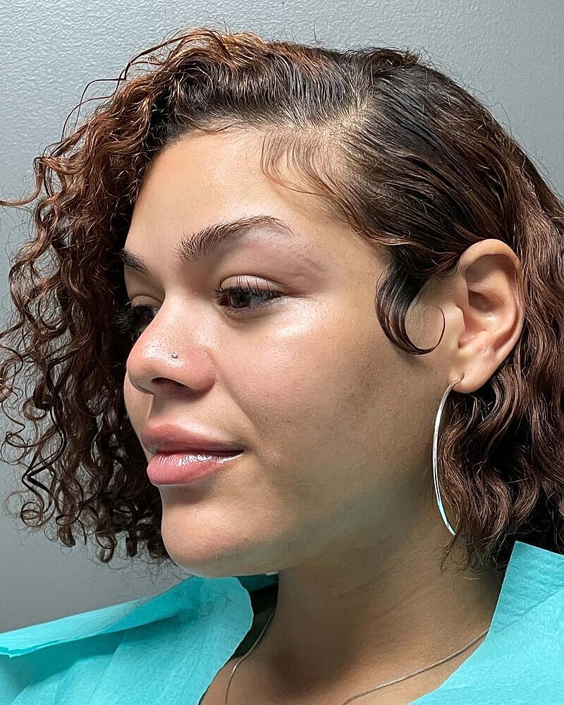 Upper Lip Lift Before & After