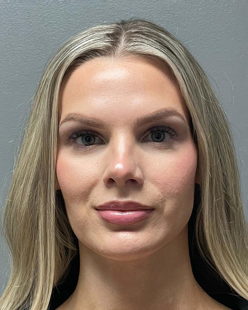 Upper Lip Lift Before & After