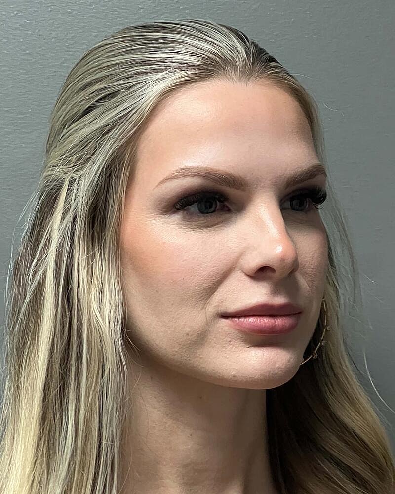 Upper Lip Lift Before & After