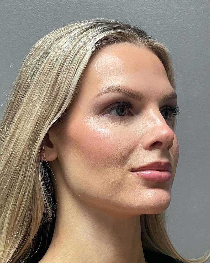 Upper Lip Lift Before & After