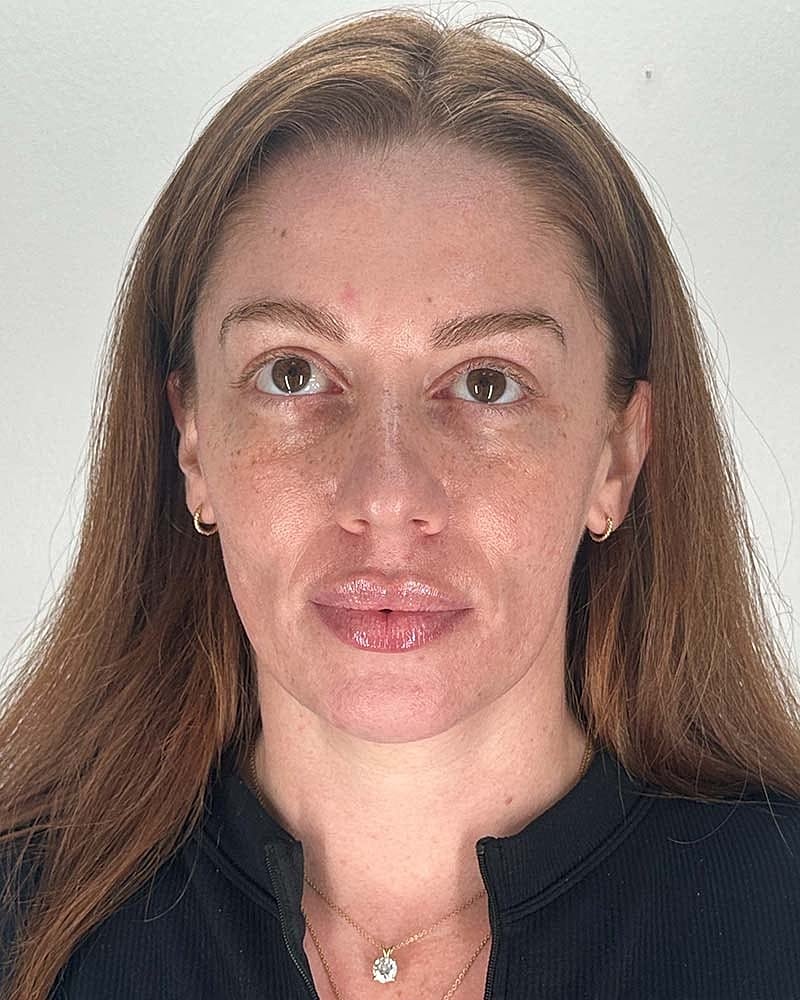 Facial Fat Grafting Before & After