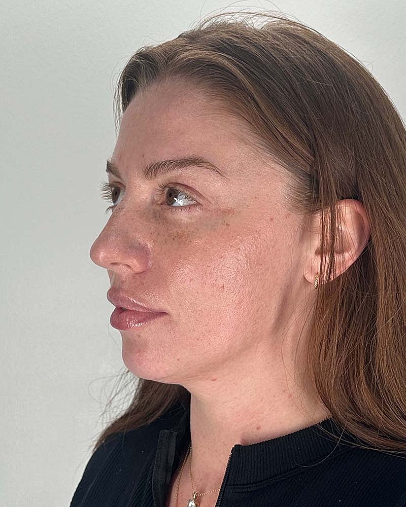 Facial Fat Grafting Before & After