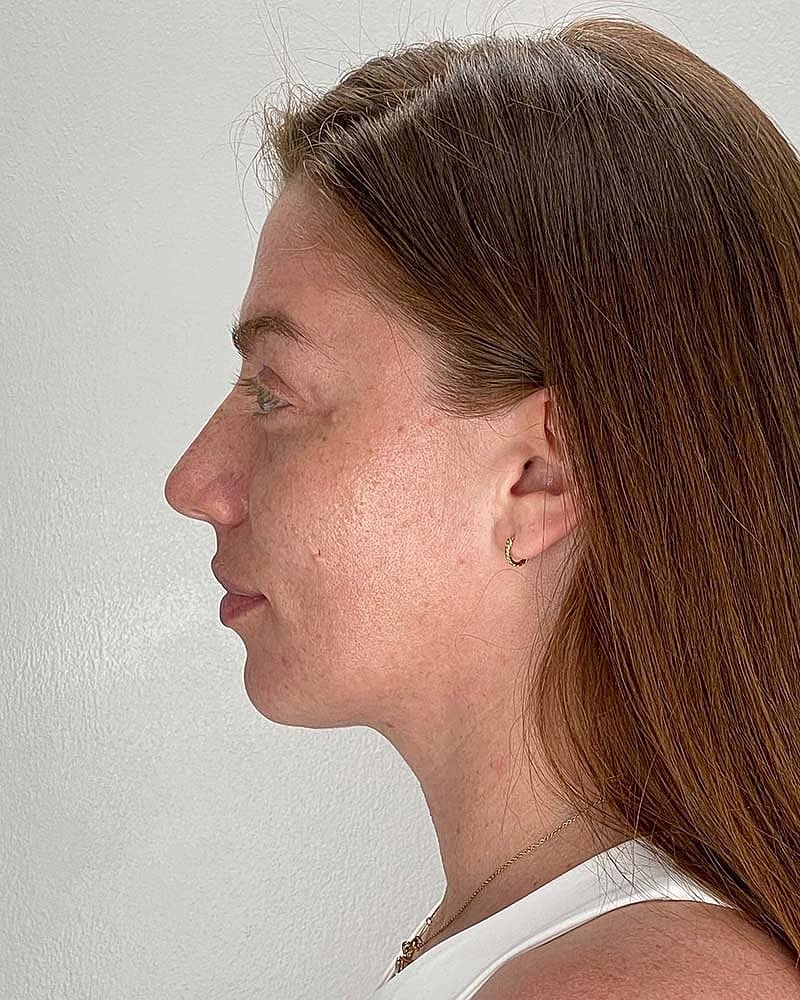 Facial Fat Grafting Before & After