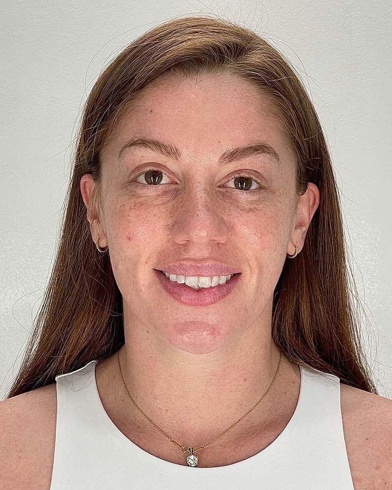Facial Fat Grafting Before & After