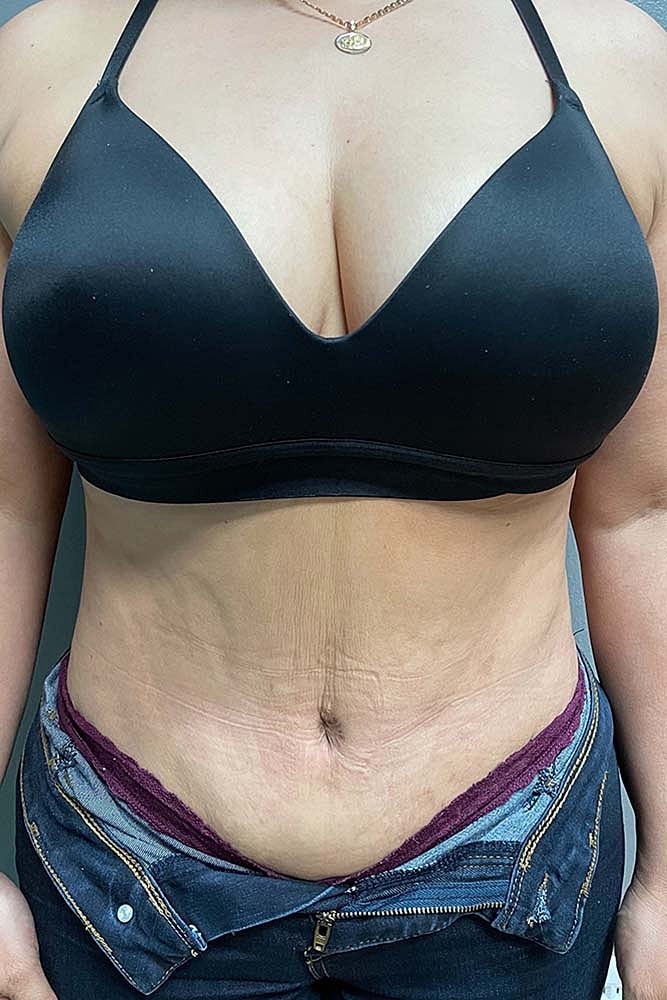 Umbilicoplasty Before & After