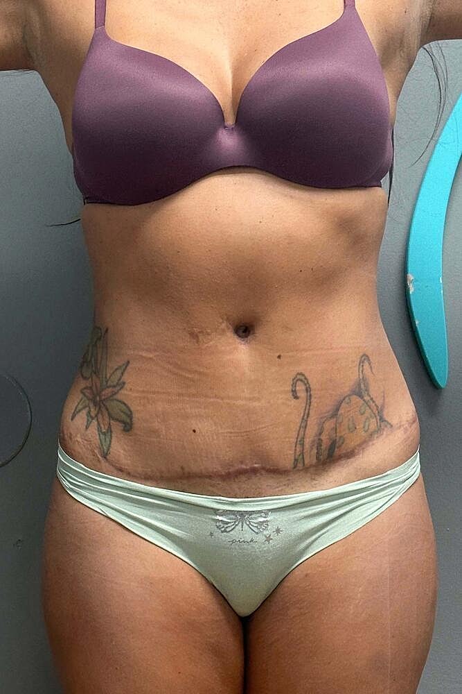 Umbilicoplasty Before & After