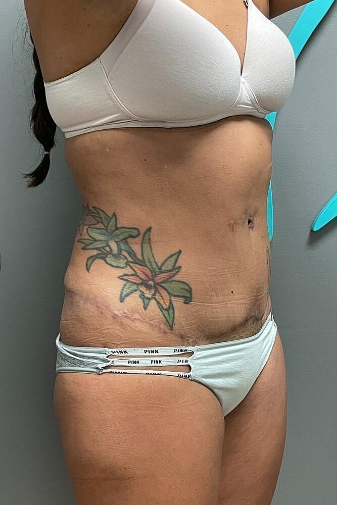 Umbilicoplasty Before & After