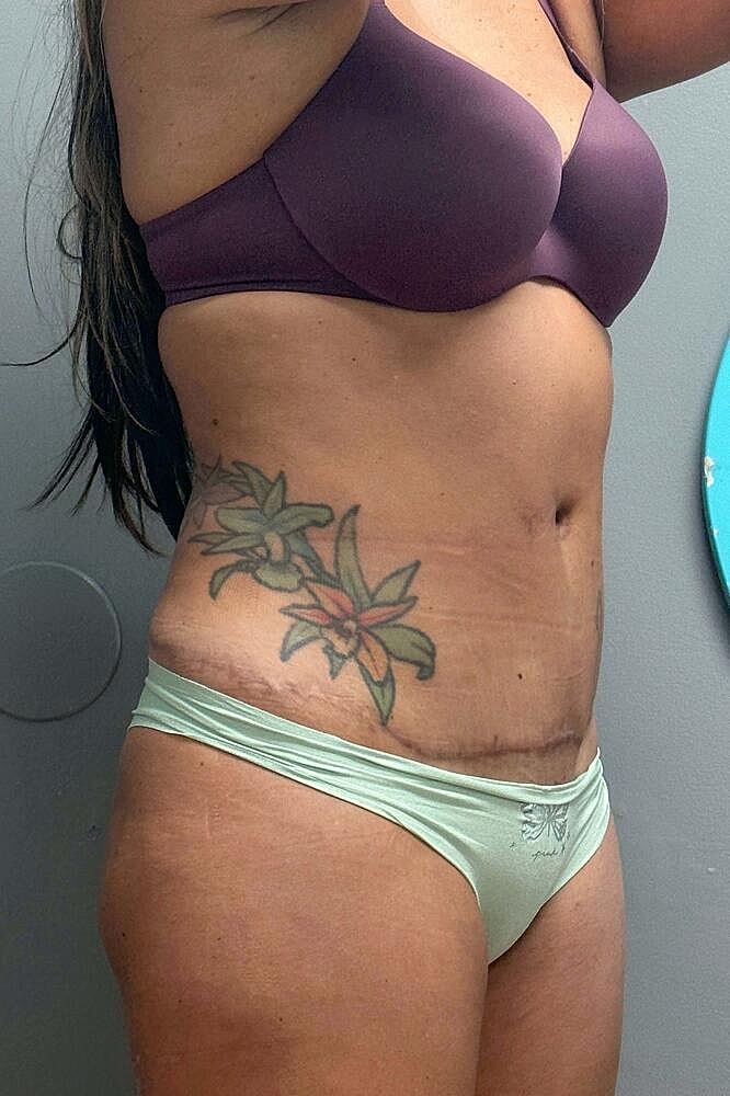 Umbilicoplasty Before & After