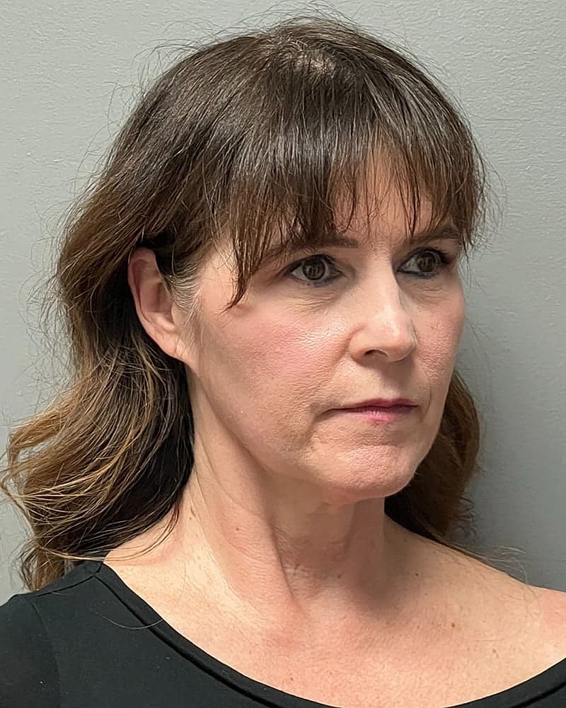 Facelift Before & After