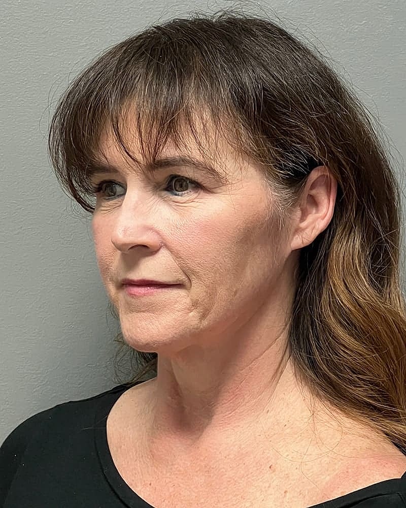 Facelift Before & After