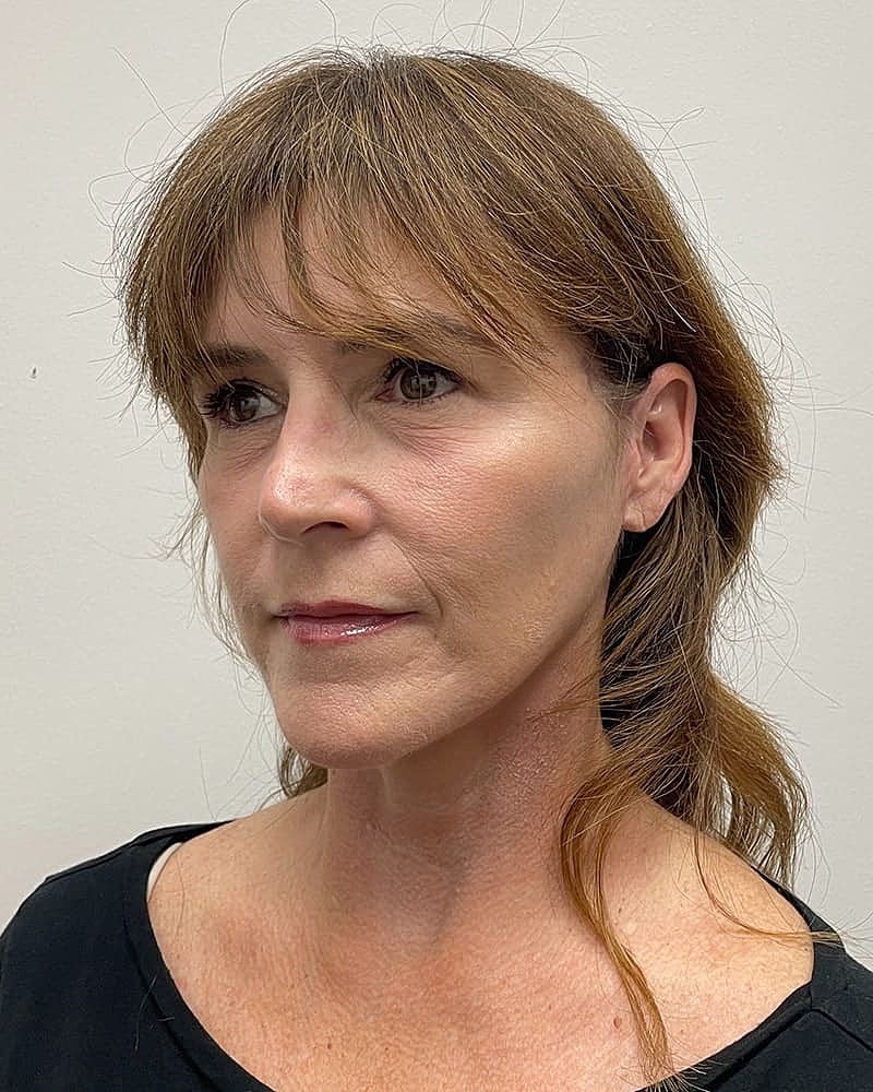 Facelift Before & After