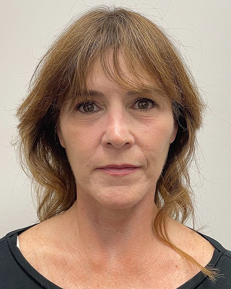 Facelift Before & After