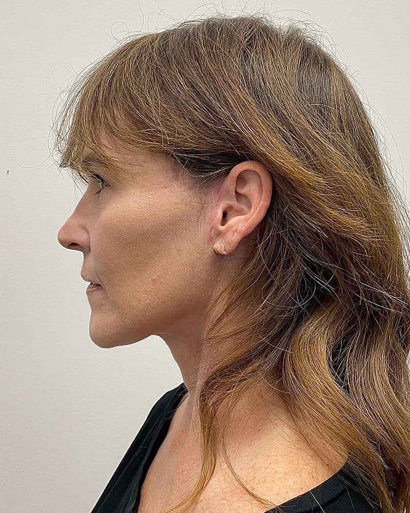 Facelift Before & After