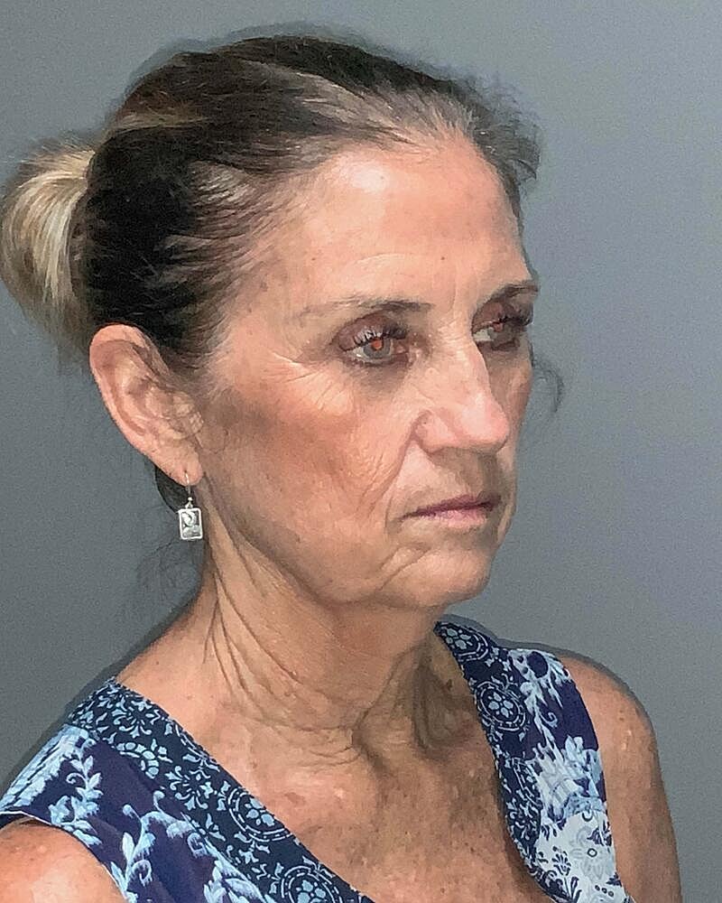 Facelift Before & After