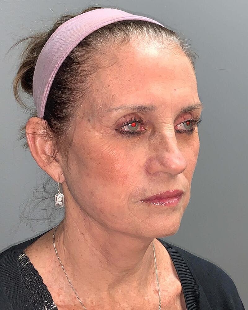 Facelift Before & After