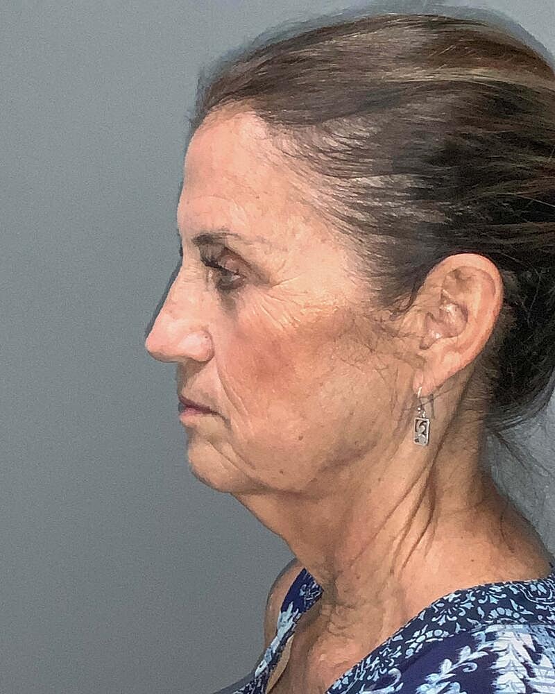 Facelift Before & After