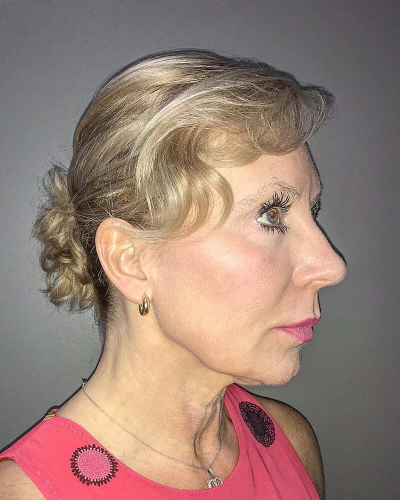 Facelift Before & After