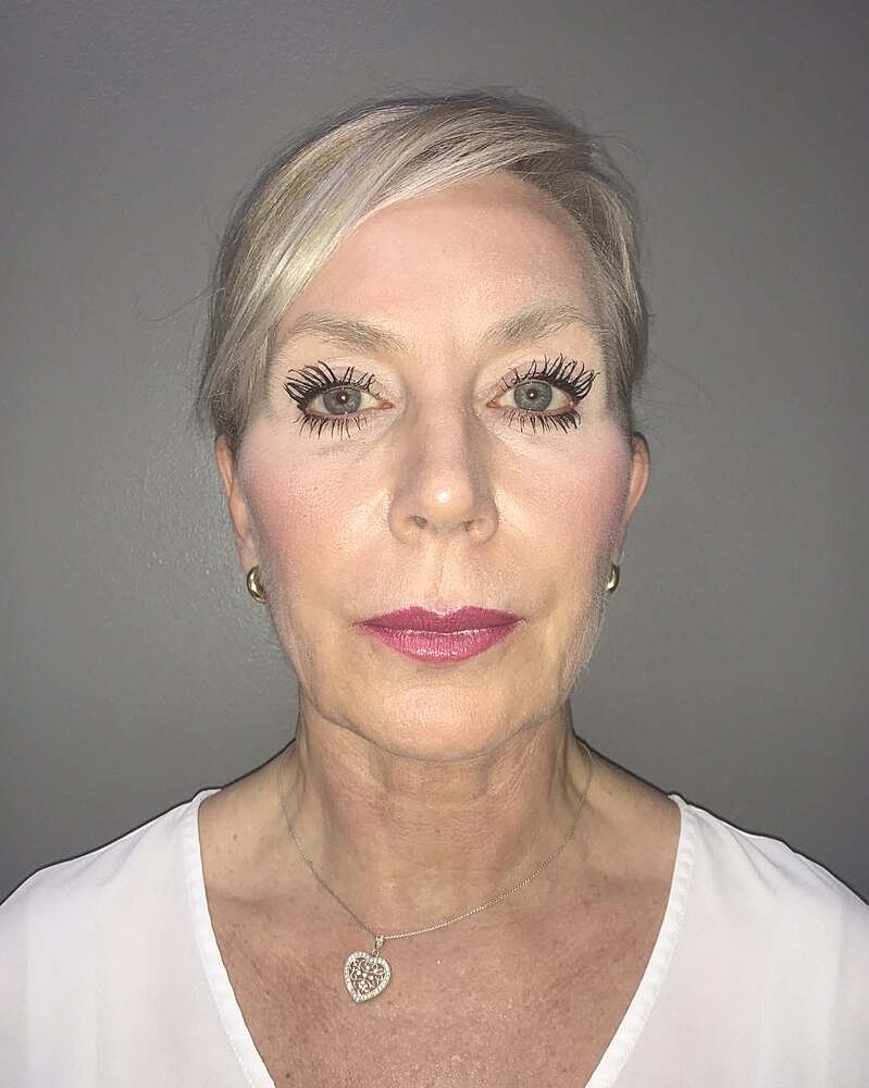 Facelift Before & After