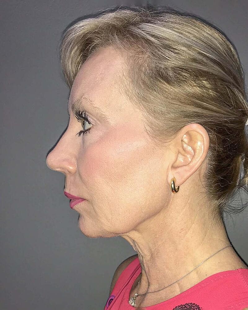 Facelift Before & After