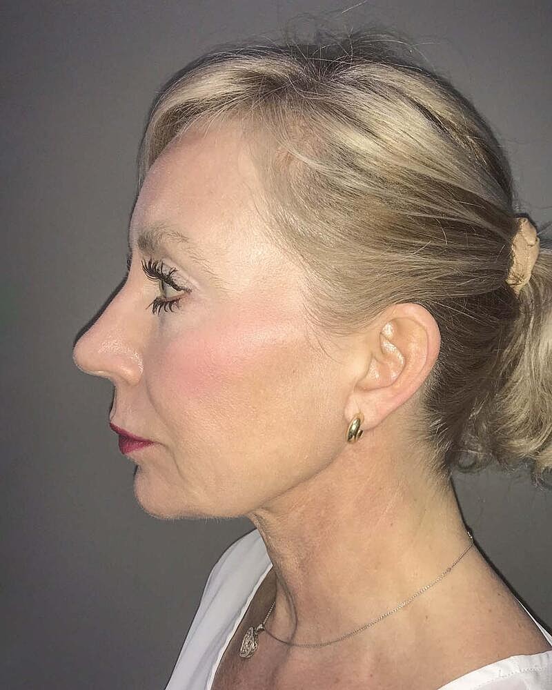 Facelift Before & After
