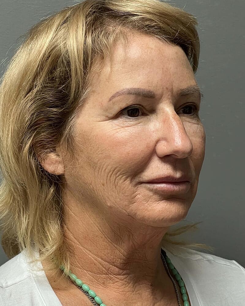Facelift Before & After