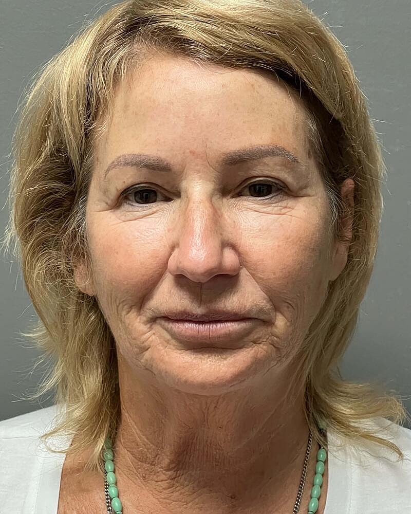 Facelift Before & After