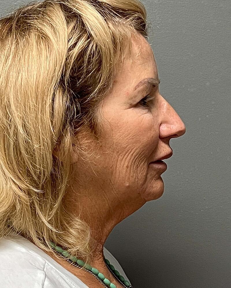 Facelift Before & After