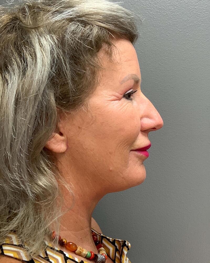 Facelift Before & After