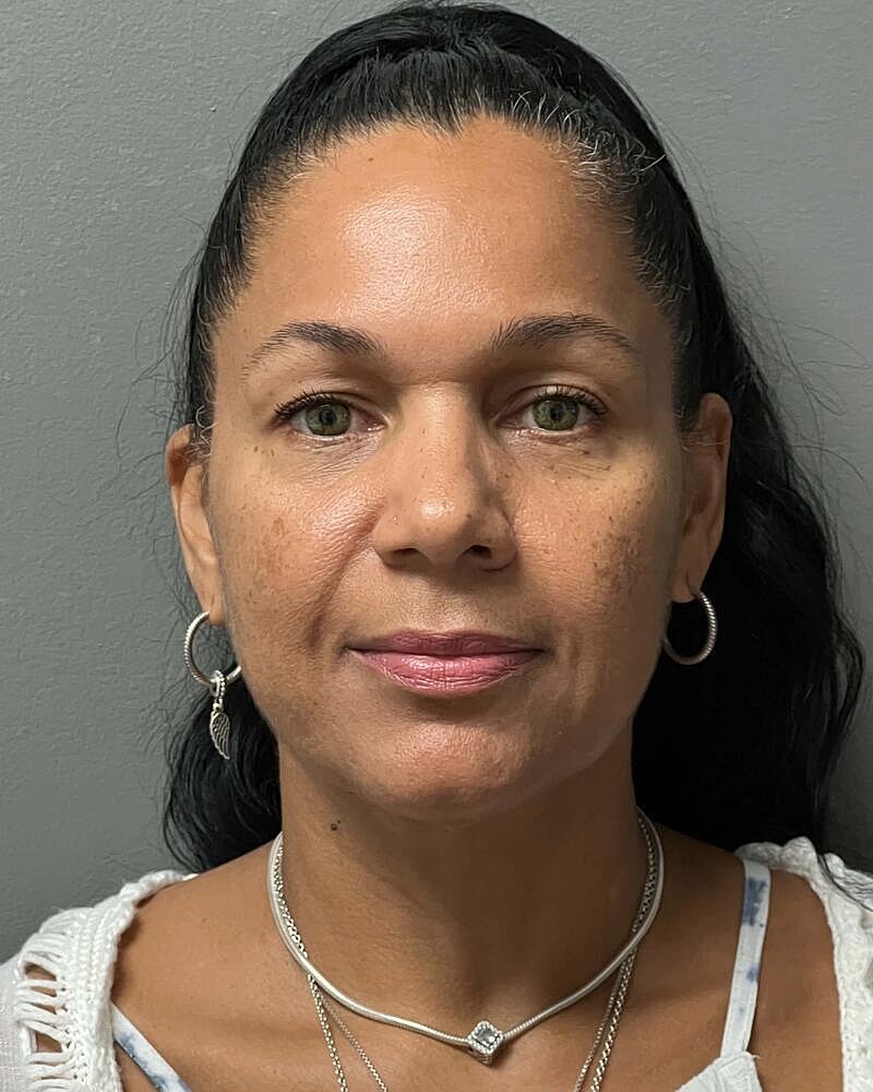 Facelift Before & After