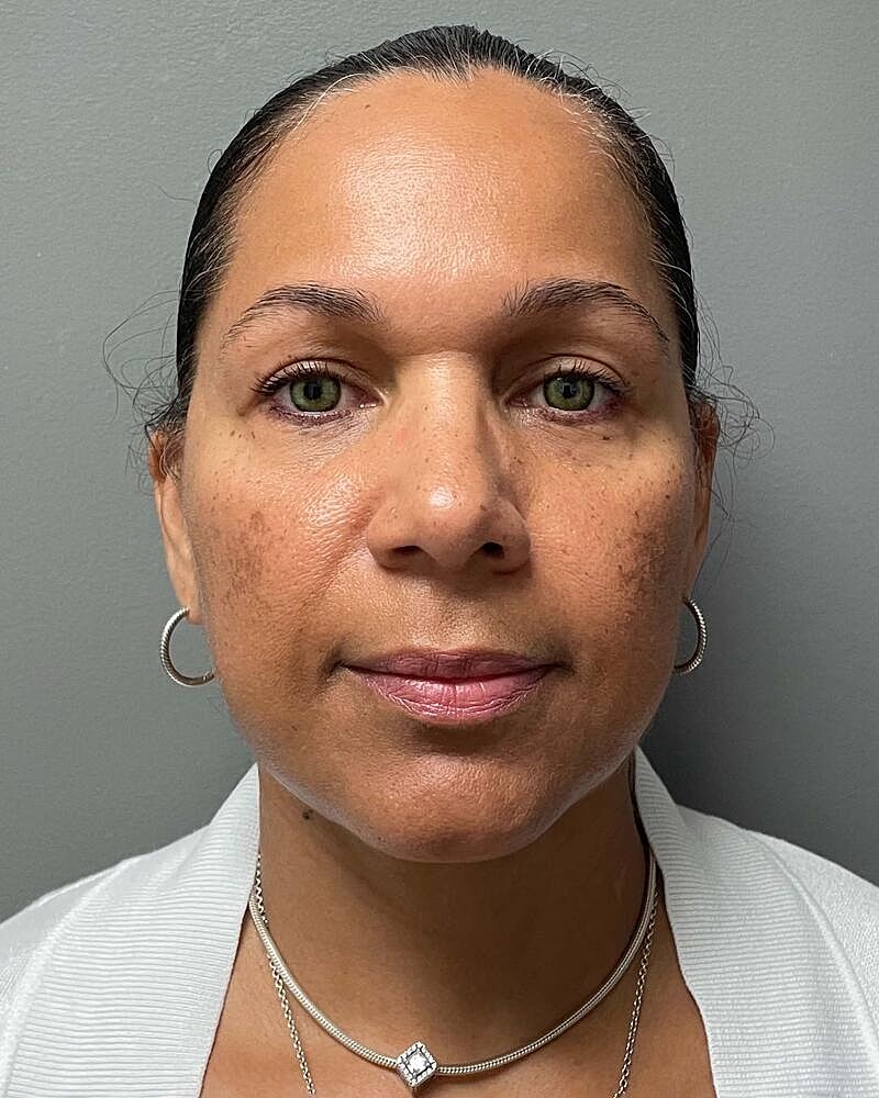 Facelift Before & After