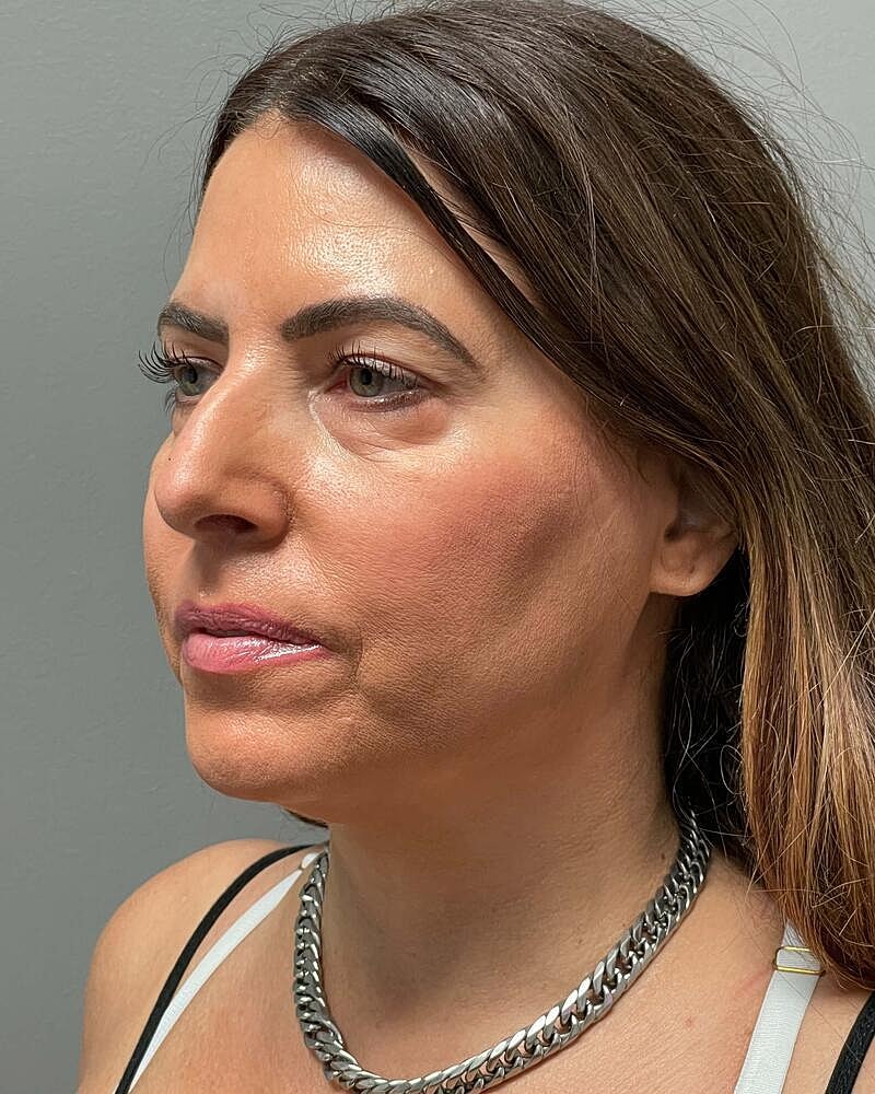 Facelift Before & After