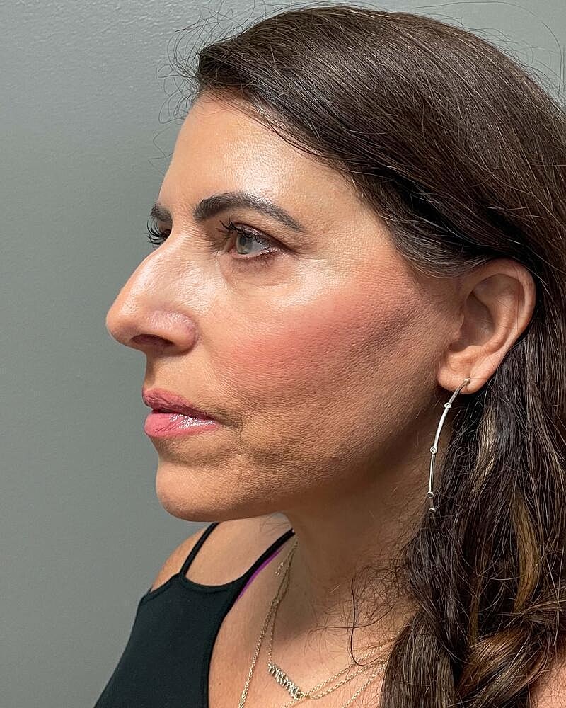 Facelift Before & After