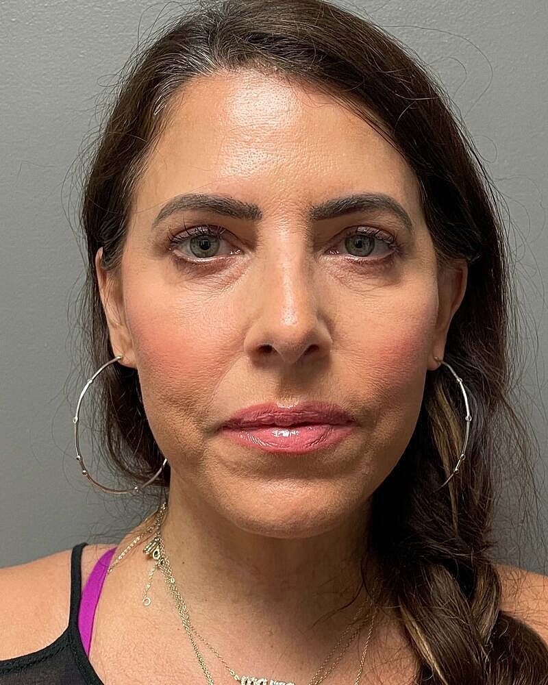 Facelift Before & After