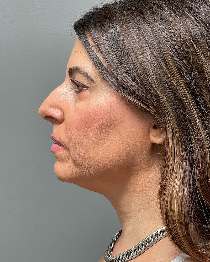 Facelift Before & After