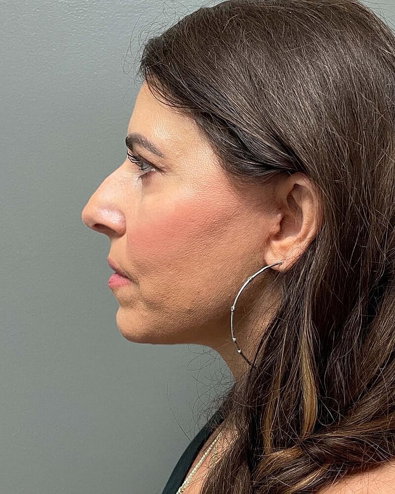 Facelift Before & After