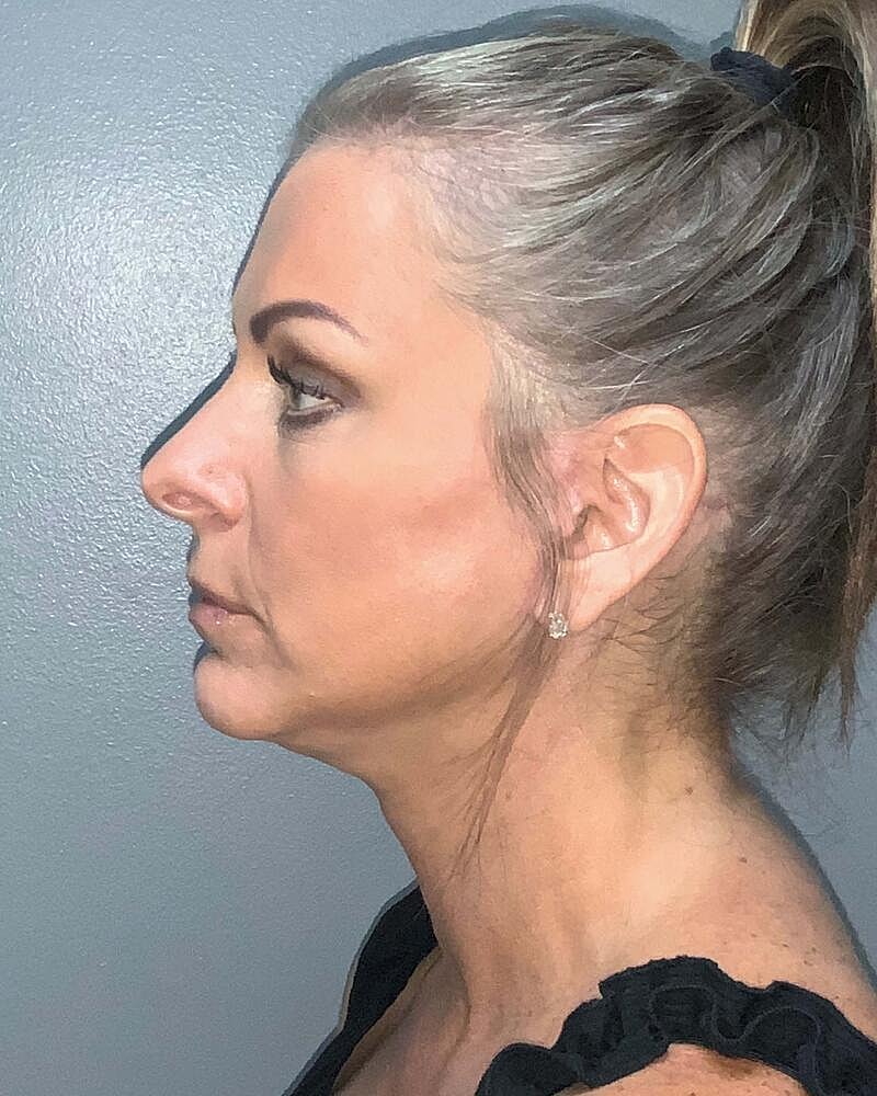 Facelift Before & After