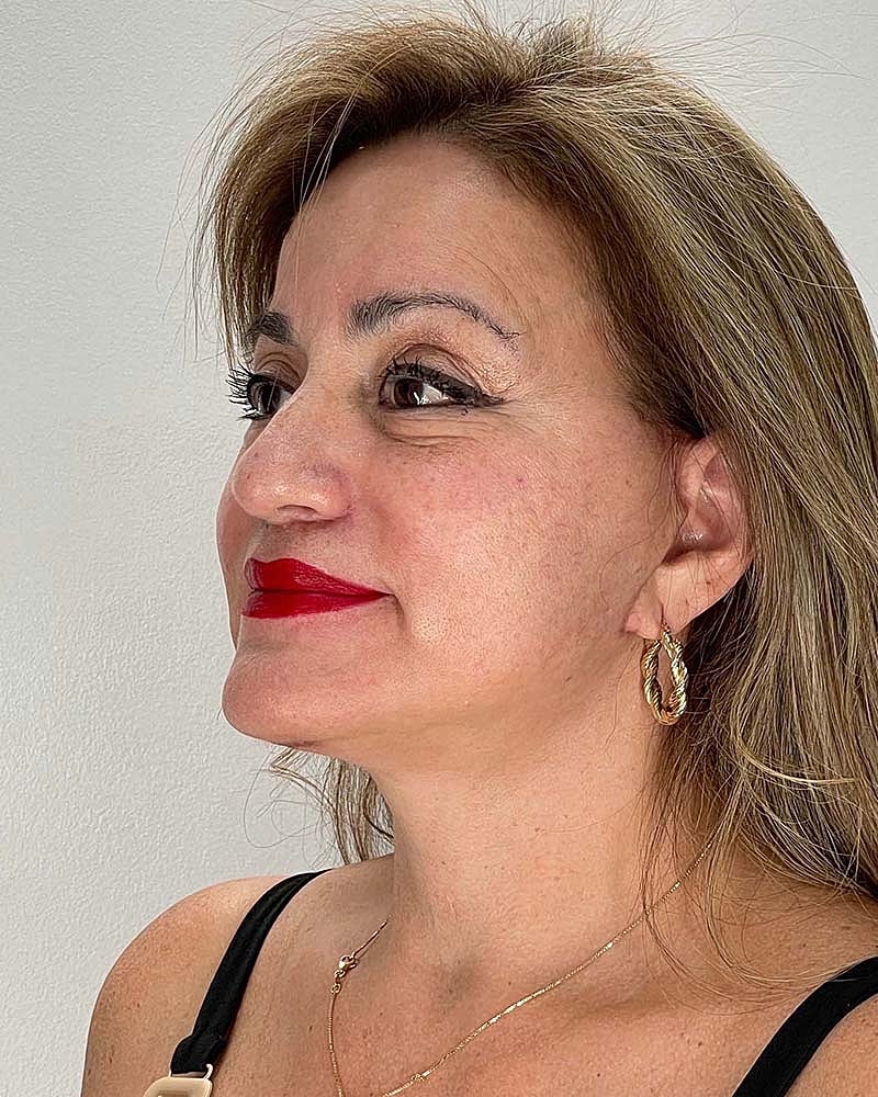Facelift Before & After