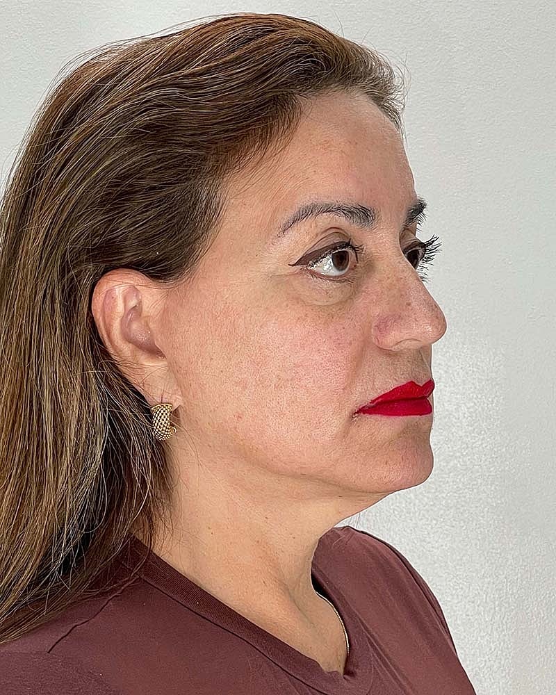 Facelift Before & After