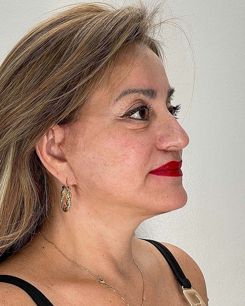 Facelift Before & After