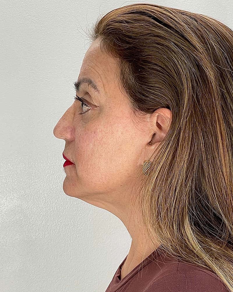 Facelift Before & After